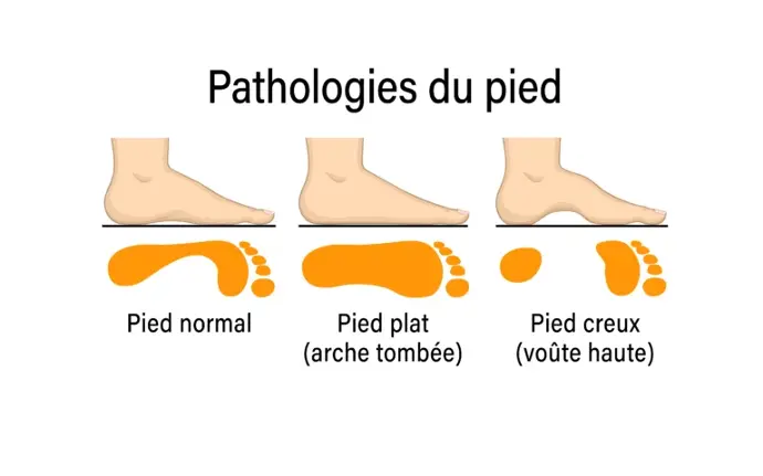 pied creux pied plat semelles orthopediques podologue savenay pied creux pied plat semelles orthopediques podologue savenay savenay