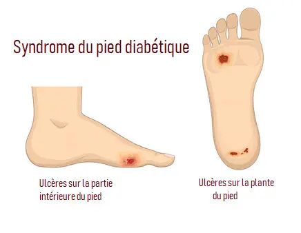 pieds diabetiques chaussures orthopediques savenay pieds diabetiques chaussures orthopediques savenay